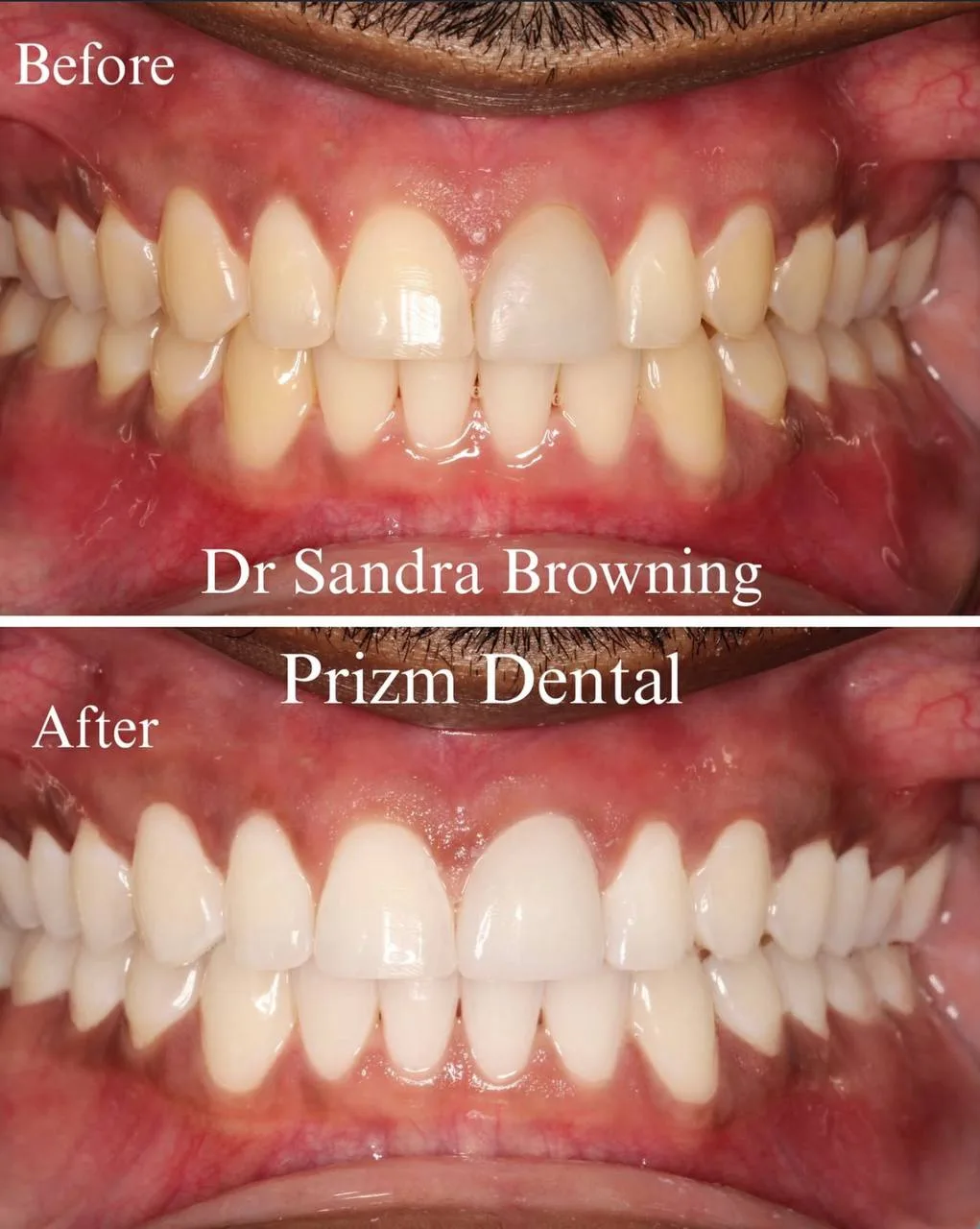 Before & After Case 12