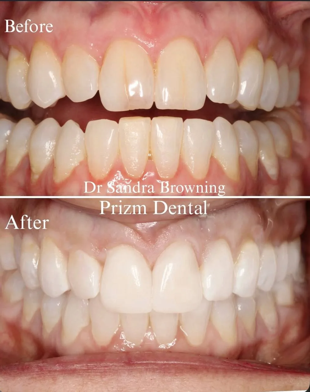 Before & After Case 13