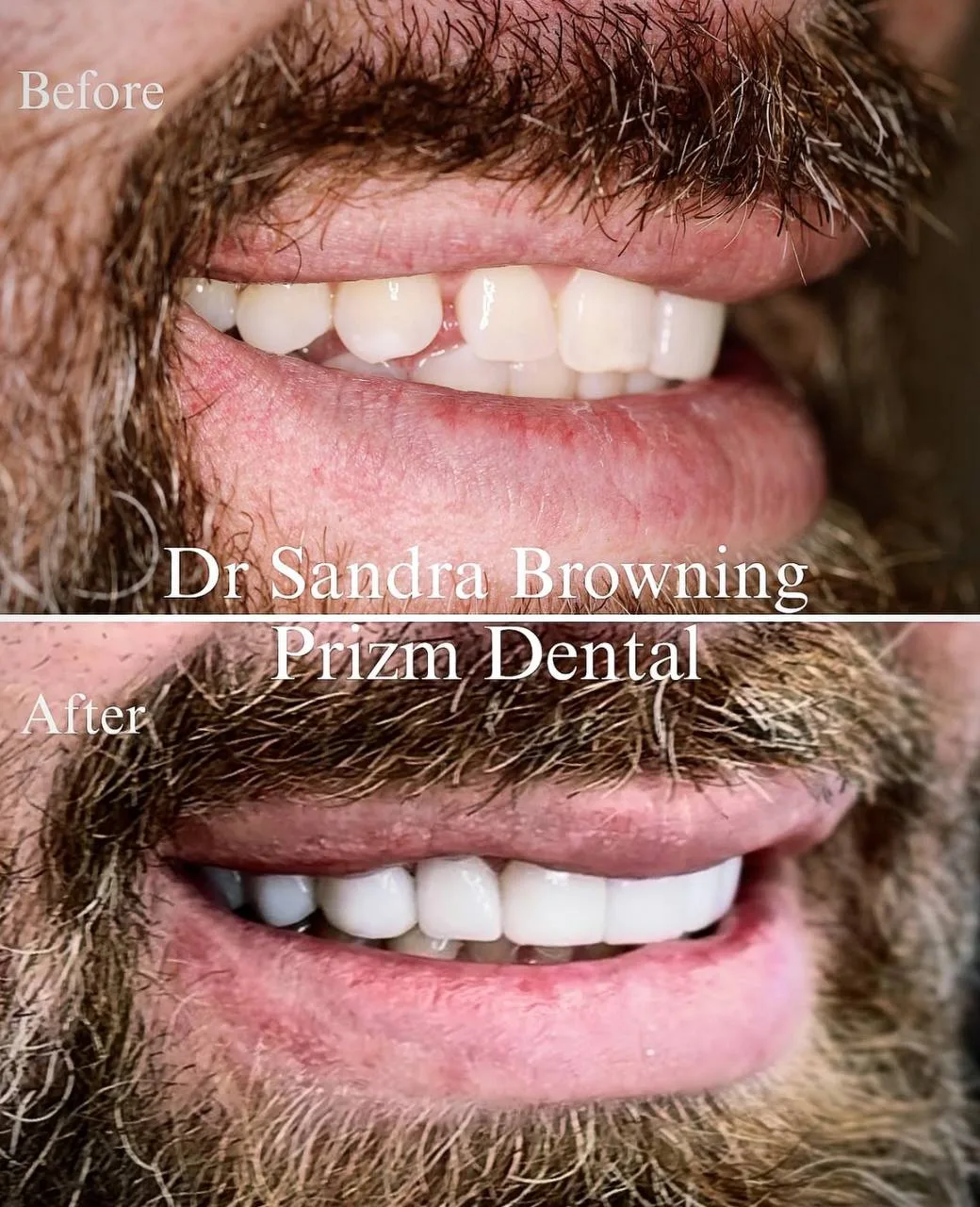 Before-and-after veneer smile transformation